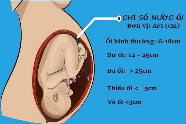 Chỉ số nước ối AFI theo tuổi thai