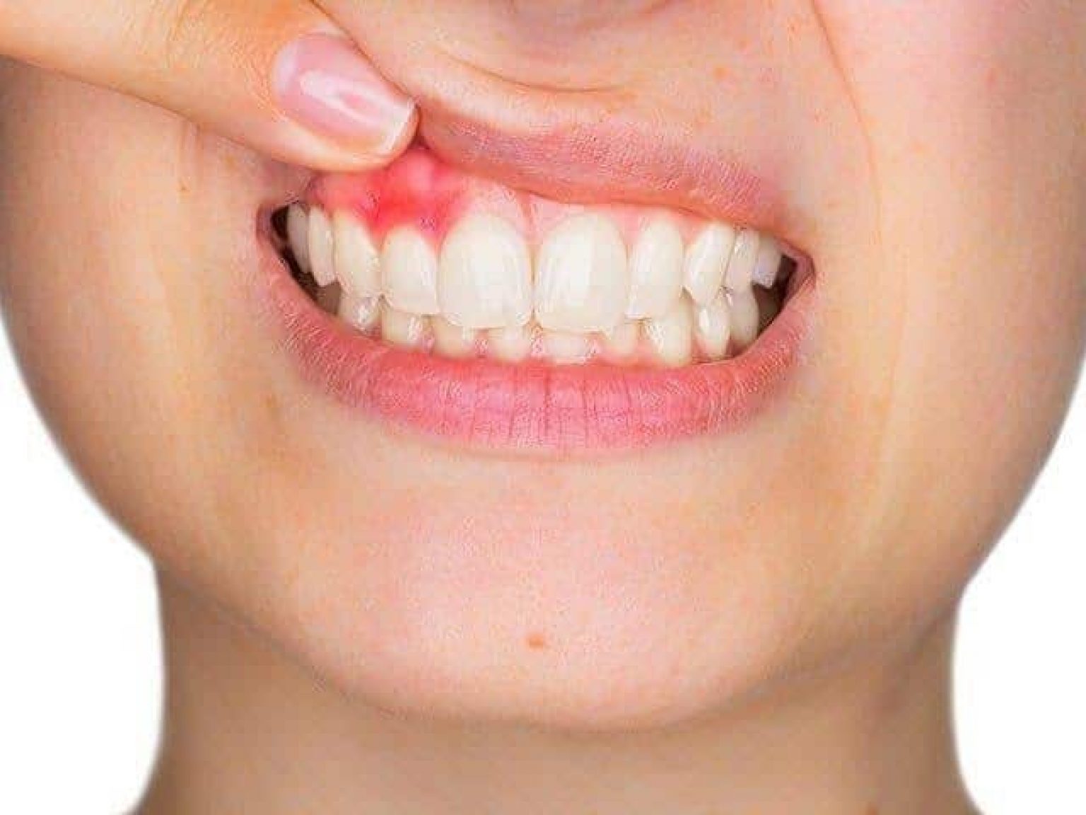 Viêm lợi chân răng