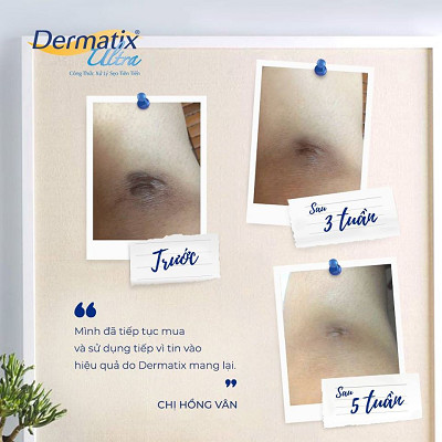 Kem trị sẹo Dermatix Ultra
